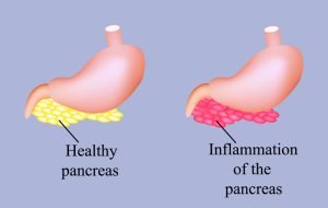 Inflammation of the pancreas