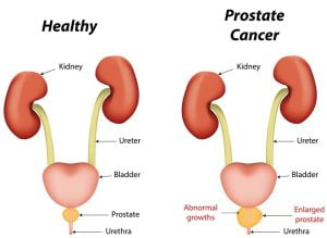 Prostate cancer image