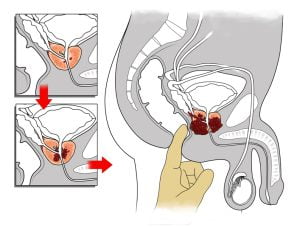Physical examination for prostate cancer screening