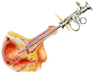 Transurethral resection procedure of the prostate