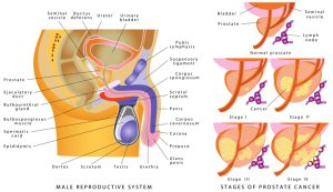 Picture of a male reproductive system and prostate cancer