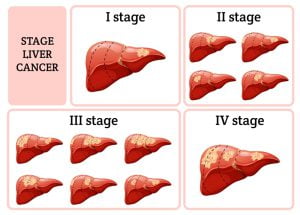 Stages of liver cancer(Hepatocellular Carcinoma)