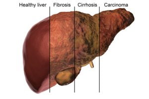Image showing effects on liver due to different liver problems