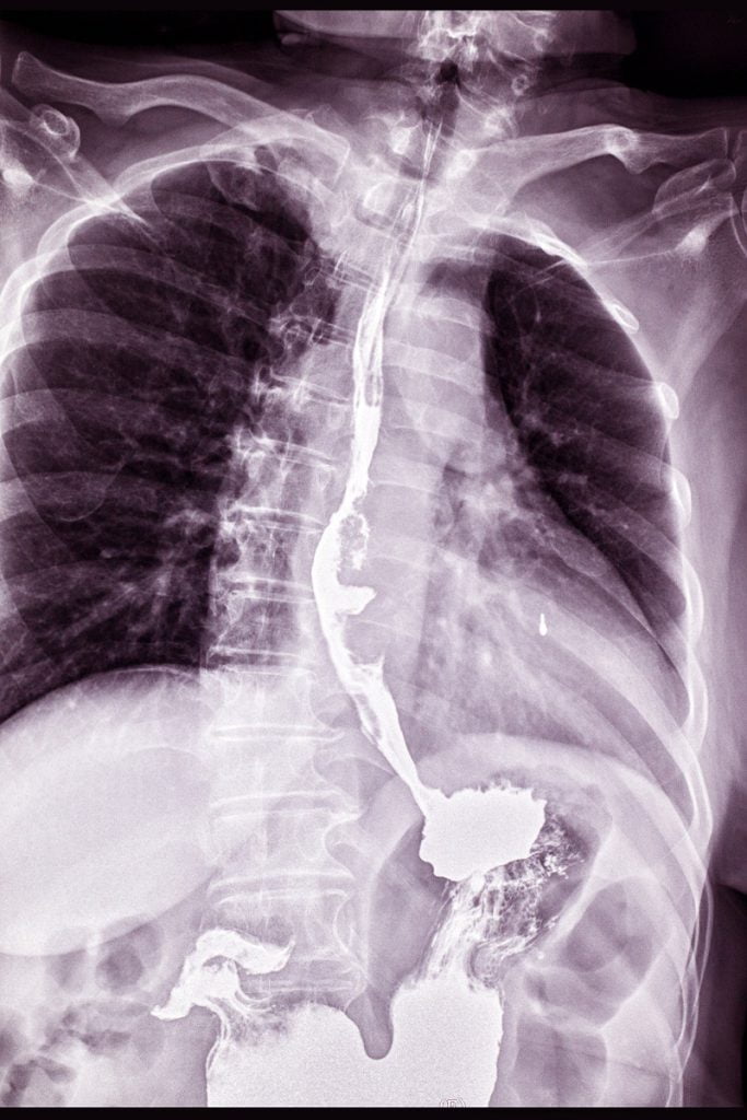 Disease Graphics, Videos & Images on Esophageal Cancer