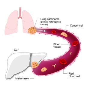 Lung cancer metastasis to liver