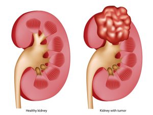 Kidney cancer image