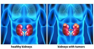 Healthy kidneys vs kidneys with cancer