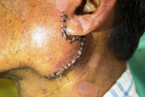 Salivary gland cancer surgery