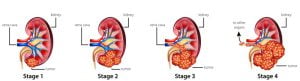 Stages of kidney cancer