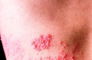 Signs and symptoms of shingles