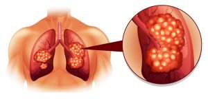 Lung cancer diagram
