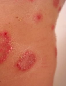 Raised red bumps and blisters due to shingles