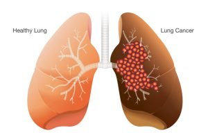 A healthy lung vs a lung with cancer