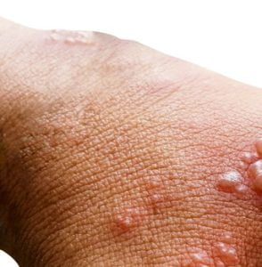 Skin infected with herpes zoster virus on the arms of a person