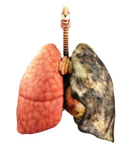 An illustration of a healthy lung vs a lung with cancer