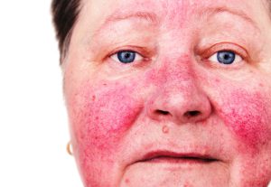 Rosacea signs and symptoms on face