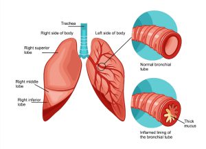 Lung cancer and bronchitis, pneumonia