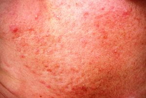 Redness on face due to rosacea