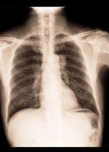 X ray image showing lung cancer in a patient