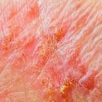 Eczema effect on hand