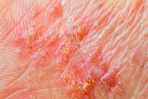 Eczema effect on hand