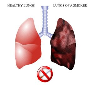 How do lungs of a smoker look like?