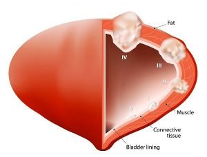 Stages of bladder cancer