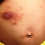 Eczema atopic dermatitis symptom