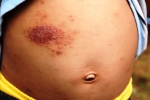 Eczema atopic dermatitis symptom