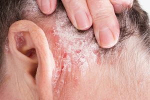 Psoriasis vulgaris