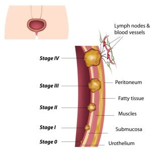 Urinary bladder cancer
