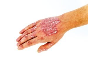 Image of psoriasis on hand