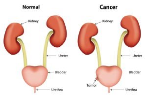 An illustration of bladder cancer