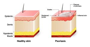 Healthy skin vs skin with psoriasis