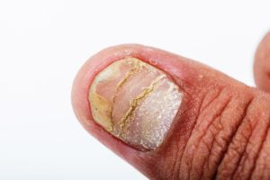Psoriasis nail image