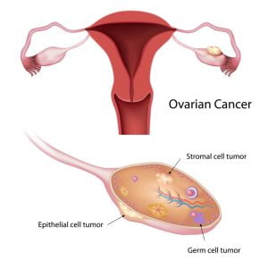 Ovarian cancer and types of tumors in ovaries