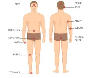 Where does psoriasis commonly affect?