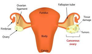 Ovarian cancer picture