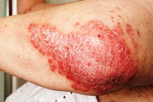 Psoriasis skin disease on elbow
