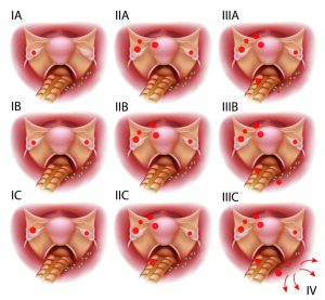Ovarian cancer stages