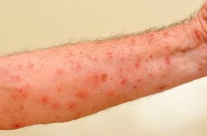 Scabies image