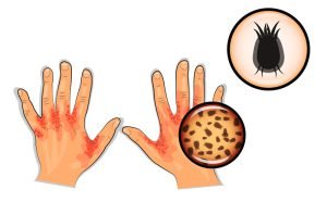 Scabies mite image