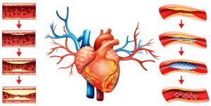 Angioplasty for coronary artery disease