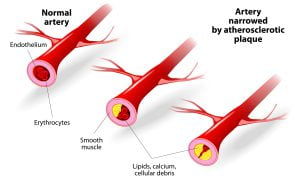A 3D illustration of plaque blocking the blood flow