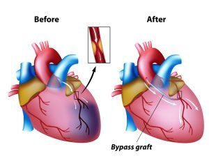 Coronary artery bypass surgery