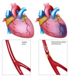 Heart attack image