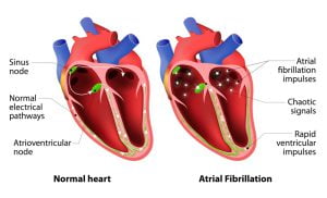 Cardiac arrhythmia irregular heart beat)