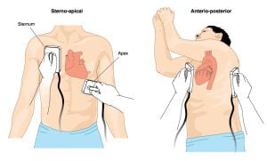 Cardioversion in people with abnormal heartbeats (arrhythmias)