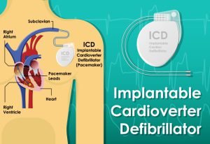 Pacemaker (ICD or Implantable Cardioverte Defibrillator)