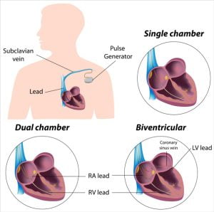 Pacemaker implant